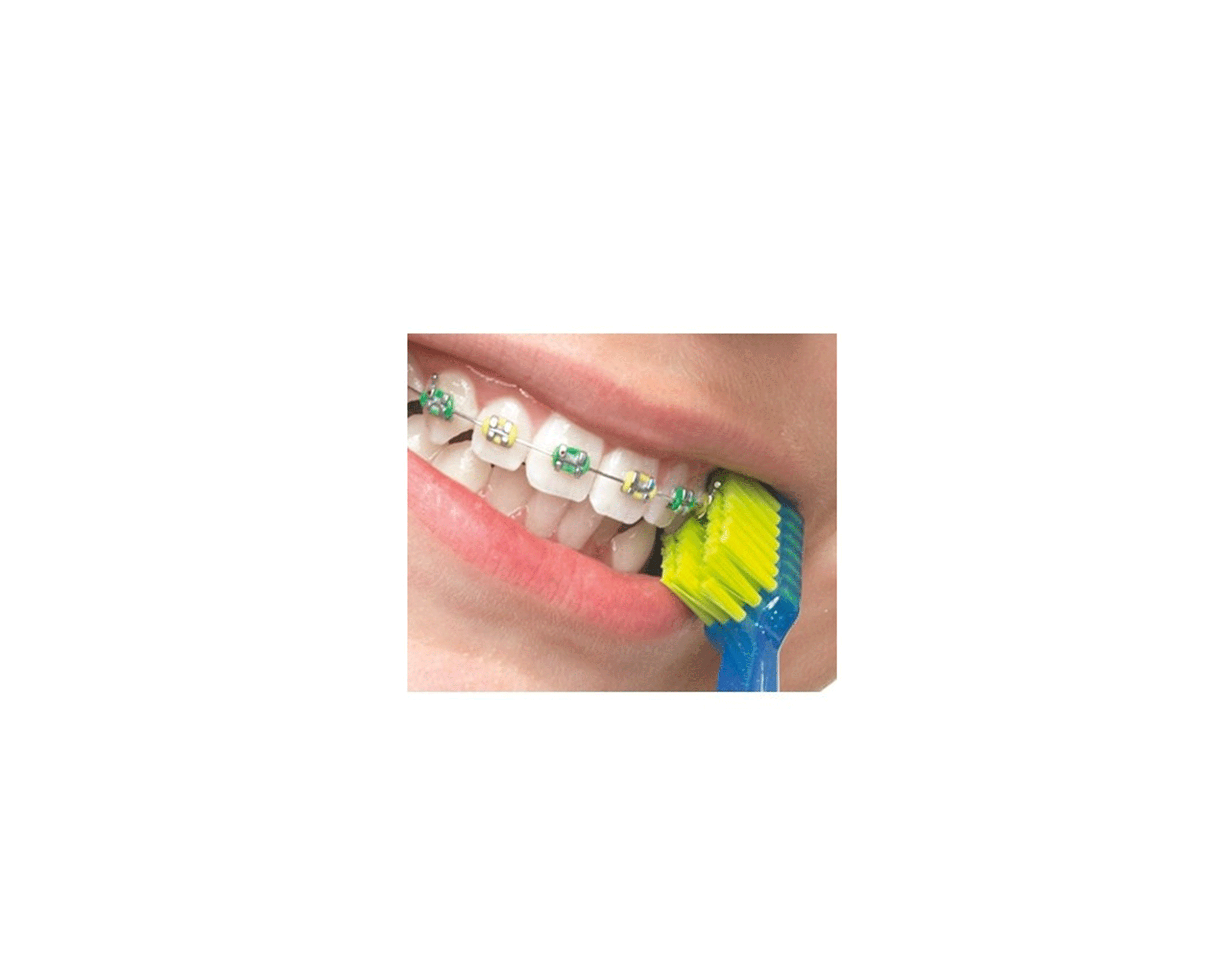Curaprox CS Ortho ultra soft (Reinigung von Brackets)